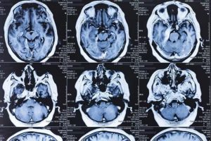 COVID-19 có thể để lại di chứng ở não người bệnh